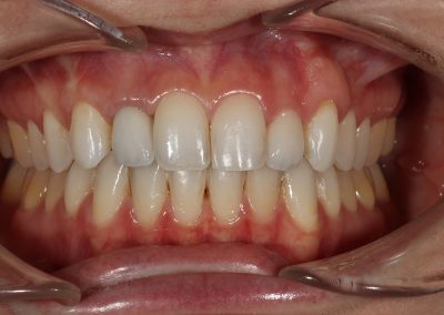 E.Max Ceramic Restoration