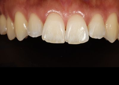 White Spot Treatment