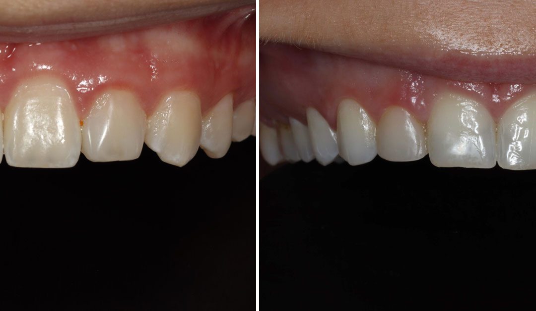 Are Dental Veneers the Right Choice for Me?