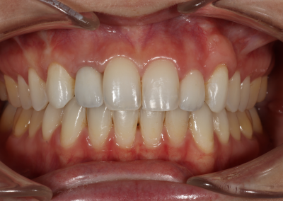 E.Max Ceramic Restoration