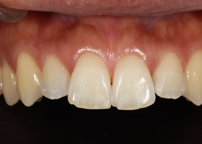 White Spot Treatment