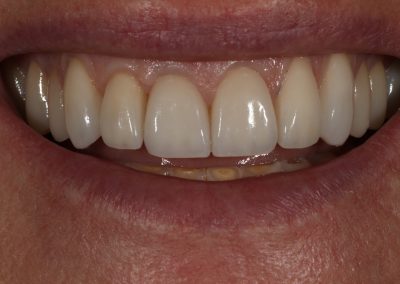 Full-Mouth Reconstruction and Smile Transformation