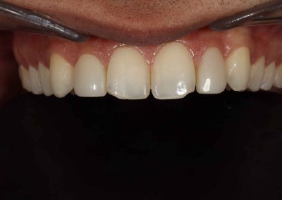 Invisalign and Composite Veneers